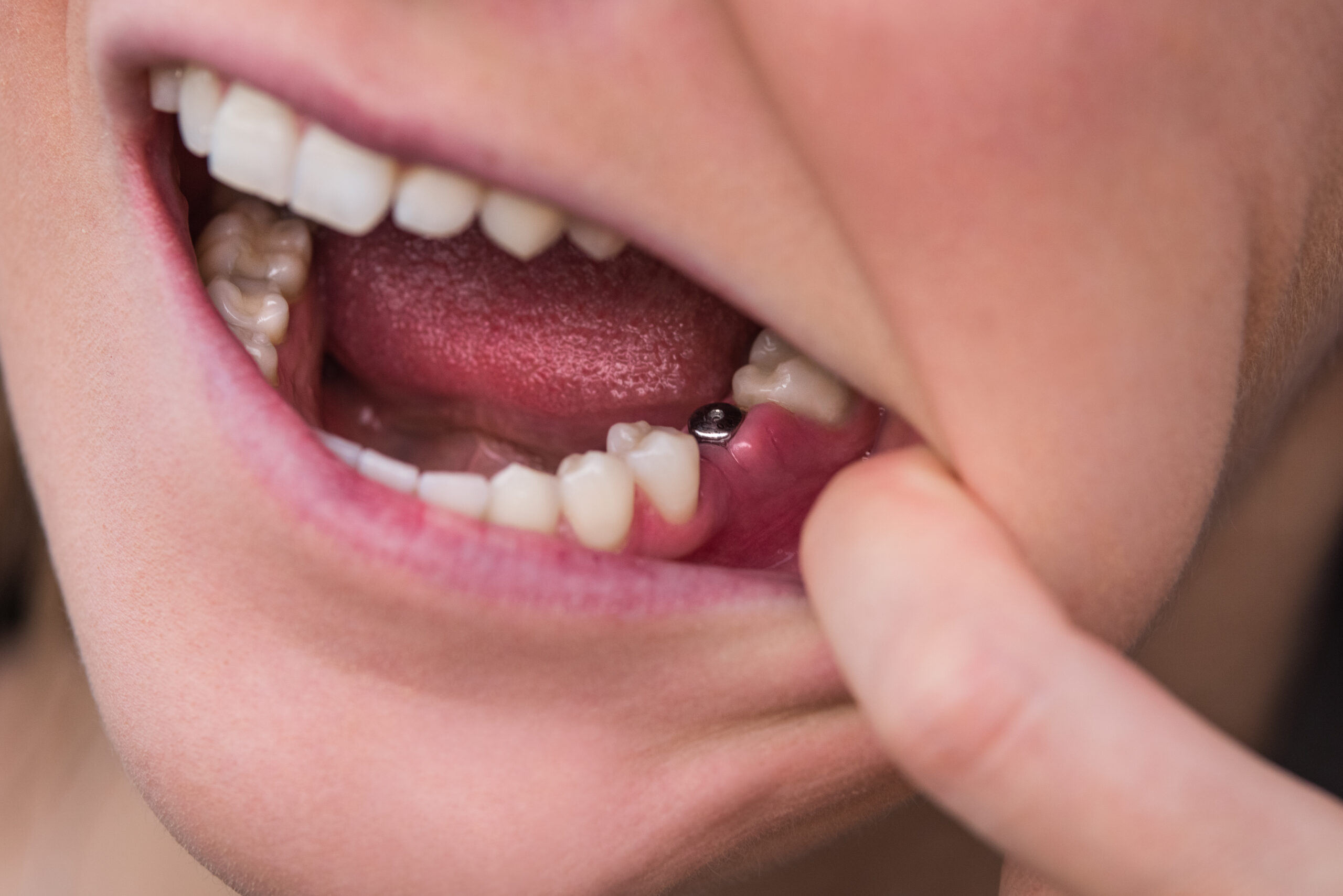 Closeup of single tooth implant.